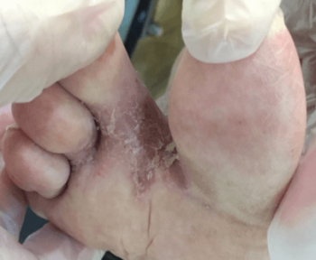 水虫の症状の例　足の指の間　3